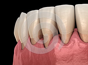 Gum recession process. Medically accurate 3D illustration