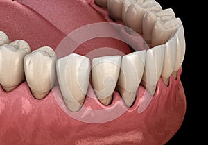 Gum recession process. Medically accurate illustration