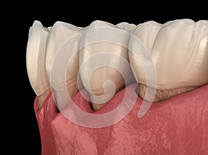 Gum recession process. Medically accurate illustration