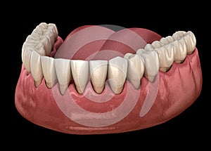 Gum recession process. Medically accurate illustration