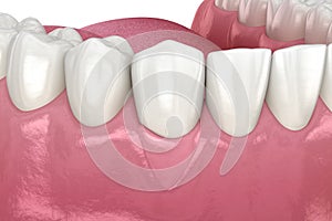 Gum Recession: Soft tissue graft surgery. 3D illustration of Dental  treatment