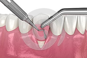 Gum Recession: Soft tissue graft surgery. 3D illustration of Dental  treatment