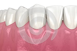 Gum Recession: Soft tissue graft surgery. 3D illustration of Dental  treatment