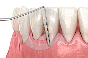 Gum recession test. Medically accurate 3D illustration