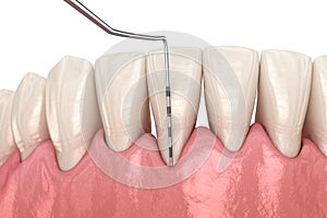 Gum recession test. Medically accurate 3D illustration