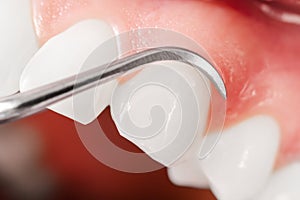 Gums and teeth examination. Close up