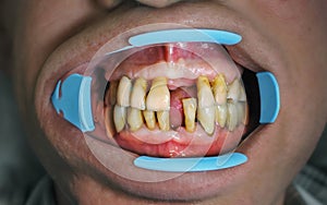 Gums and tooth structure have been worn away leading to exposed