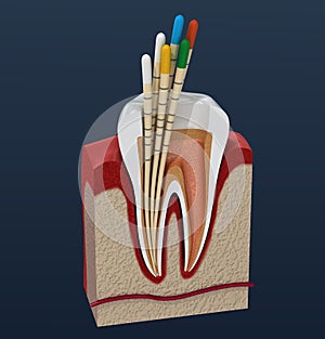 Gutta percha endodontics instrument, dental anatomy. illustration