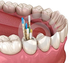 Gutta percha root canal treatment process. Medically accurate tooth 3D illustration