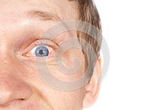 The guy eye disease