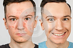 Dos los chicos a la izquierda chico acné manchas piel la ley chico saludable piel. acné tratamiento 