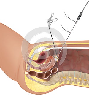 Gynaecological Laparoscopy procedure. Laparoscopic instruments. Surgery. Fertilization by extracting eggs.