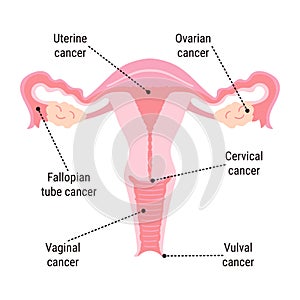 Gynecological Cancer Awareness Month infographic. Main types of cancer cervical, ovarian, uterine, vaginal and vulvar in woman photo