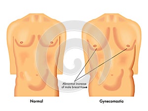 Gynecomastia