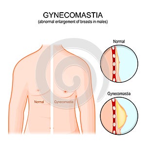 Gynecomastia. Torso of healthy man and abnormal enlargement of breasts in male