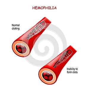 Haemophilia. hemophilia. healthy blood vessel after bleeding and blood vessel with Coagulation disorder