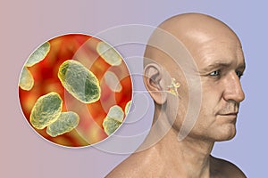 Haemophilus influenzae bacteria as a cause of otitis media