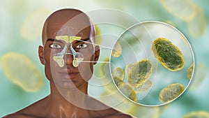 Haemophilus influenzae bacteria as a cause of sinusitis photo