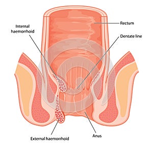 Haemorrhoids shown in cross section of anal canal