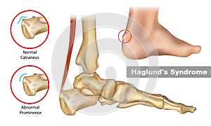 Haglund's deformity is an abnormality of the bone and soft tissues in the foot. An enlargement of the bony section of