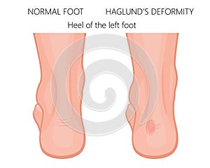 Haglund`s deformity of the heel