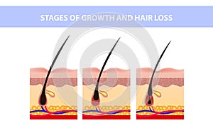 Hair growth phase step by step. Stages of the hair growth cycle. Anagen, telogen, catagen. Anatomy of the skin. Cross section of