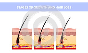 Hair growth phase step by step. Stages of the hair growth cycle. Anagen, telogen, catagen. Anatomy of the skin. Cross section of photo