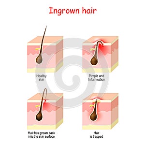 Hair ingrown