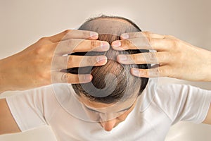 Hair loss