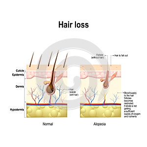 Hair loss, alopecia, baldness photo