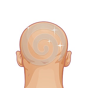 Hair loss. Bald hairstyle alopecia man problem vector medical health illustration