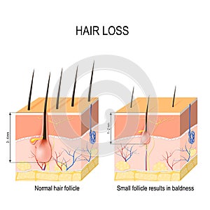 Hair loss baldness. Normal hair follicle and skin with Alopeci photo