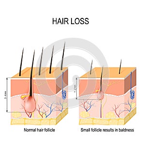 Hair loss baldness. Normal hair follicle and skin with Alopeci