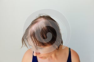 Bald patches of total alopecia of a woman