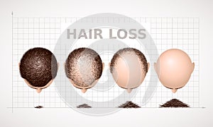 Hair loss. Graph of four stages of alopecia