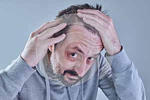 Hair loss. Man concerned about losing hair on his forehead and temple