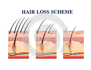 Hair Loss Scheme