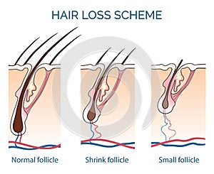 Hair loss scheme