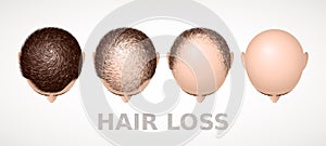 Hair loss. Set of four stages of alopecia