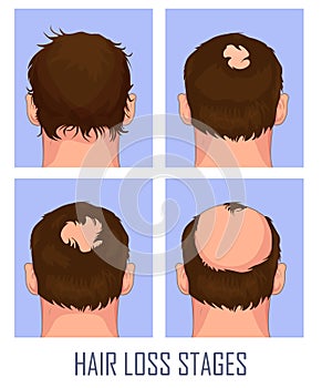 Hair loss. Stages of alopecia man problem vector medical health illustration