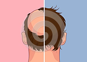 Hair loss. Stages of alopecia man problem vector medical health illustration Before after
