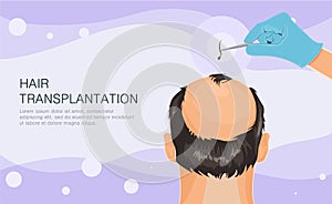 Hair loss. Stages of alopecia man problem vector medical health illustration Hair transplant illustration