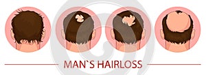 Hair loss. Stages of alopecia process man problem vector medical health illustration