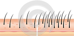 Hair loss stages set of before and after steps. Side view of a man losing hair before and after hair treatment and transplantation