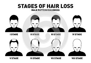 Hair loss. Stages and types of male hair loss. Male pattern baldness. Head of hairy and bald man in top view