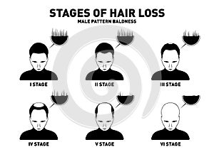 Hair loss. Stages and types of male hair loss. Male pattern baldness. Head of hairy and bald man in top view