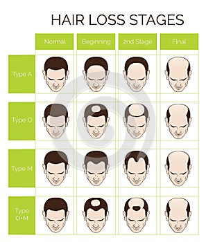 Hair loss stages and types for men