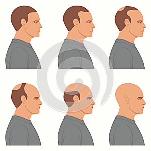 Hair loss stages vector isolated. Male alopecia. Set of balding process. Hairless man heads side view.