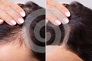 Before And After Hair Loss Treatment photo