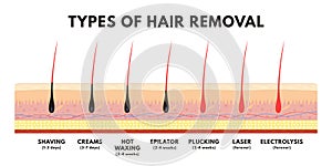 Hair removal concept. Shaving, depilation cream, waxing, epilator, plucking, laser hair removal and electrolysis photo